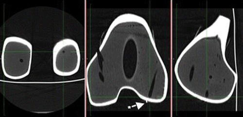 Figure 4. Image processing and vector calculation was performed based on postoperative CT scans in the three planes of the drilling axis in the femoral condyles. In the center panel, the star indicates a metal ball applied to enable visualization of the marked osteochondral lesion in the CT scans.