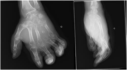 Figure 1. X ray of the left hand showing complete lysis of the Fourth metacarpal bones.