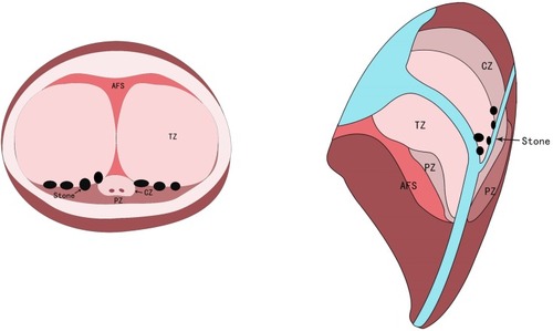 Figure 4 Zonal classification of the prostate and prostatic calculi.