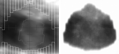 Figure 2.  Comparison of the digitally reconstructed radiograph (DRR) and portal image. Left: DRR generated in planning system to simulate a 6 MV beam (showing the position of the multileafs and the gross target volume); right: inverted portal image frame with window and levelling adjusted to make the tumour visible.