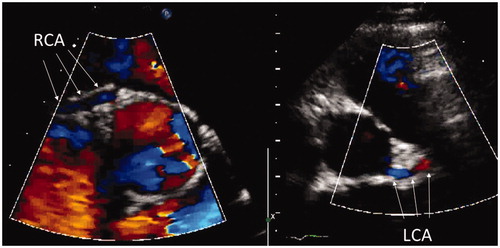 Figure 4. Standard parasternal short axis view: the search for coronary arteries is started with color Doppler mapping. Doppler velocity range should be set with a low Nyquist limit (15–20 cm/s).