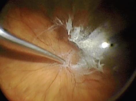 Figure 2 Triamcinolone staining of residual vitreous cortex.