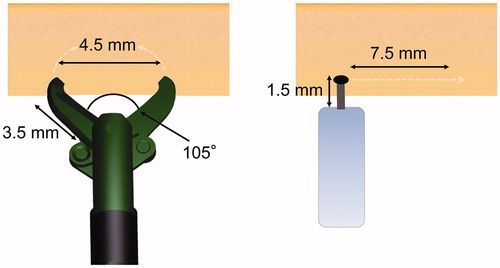 Figure 6. Schema for SB Knife Jr and the conventional tip-type knife. SB Knife Jr has a forceps length of 3.5 mm, an opening width of 4.5 mm, and an opening angle of 105°. Assuming a fan-shaped dissection surface, a single grasp and dissection action enables the clinician to cut approximately 11.2 mm2 of tissue. In contrast, assuming a rectangular dissection surface, the tip-type knife with a 1.5 mm forceps length requires a horizontal movement of approximately 7.5 mm to cut the same length of tissue. In the difficult-to-operate large intestine, these movements require advanced endoscopic techniques.