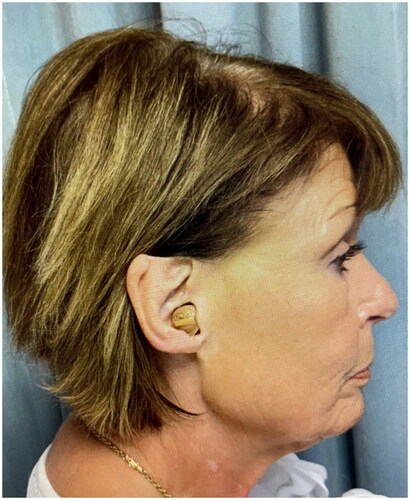Figure 1. 2.5 × 1.5 cm full-thickness defect extending from the right mid-helical crus to the level of Darwin’s tubercle that included the skin and cartilage.