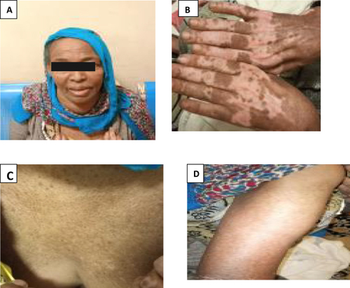 Figure 3 Skin manifestation of dermatomyositis in thyroid cancer patient at University of Gondar Hospital (ffter 2 months of treatment). (A) skin manifestation on face (heliotrope rash), (B) Gutron’s papule, (C) V-sign, (D) holster sign.