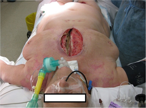 Figure 1 Deep sternal wound infection in a patient.