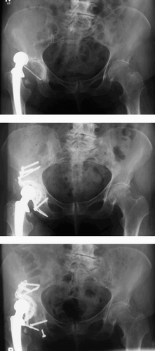 Figure 3. A 67-year-old woman received a hip replacement for primary osteoarthrosis. After 6 years, the cup was revised because of recurrent dislocation and symptomatic aseptic loosening. After 3.7 years, she had experienced increasing pain. There was a severe dislocation of the Burch-Schneider ring; two screws were broken. The migration was 18 mm, and the wear 0.81 mm. The cup had to be re-revised.