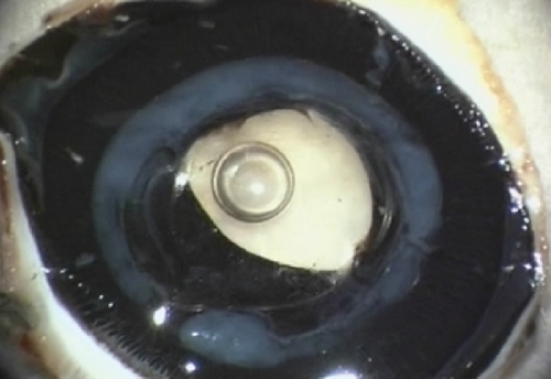 Figure 7 Gross photograph (Miyake–Apple posterior view technique) showing an Acrysof SA 60 AT. You can see the intense Sommering’s ring (grade 4, white ring). Note the distortion of the haptics of the intraocular lens which are compressed by Sommering’s ring and are bent over the optic.