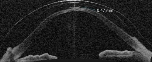Figure 2 ASOCT in a patient with keratoconus with vault measured as 0.47 mm.