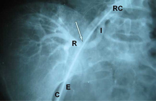 Figure 1. The internal iliac artery is anastomosed end-to-end to the renal allograft artery. There is a significant circular stenosis, 5 mm in length at the site of anastomosis (arrow). This is overshadowed by the external iliac artery. Abbreviations: right common iliac artery (RC), internal iliac artery (I), renal artery (R), external iliac artery (E), catheter (C).