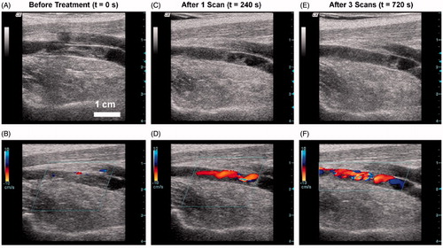Figure 4. Ultrasound images of the femoral vein captured by a linear array imaging probe between treatments of a thrombus. (A, B) The original appearance of the vessel on 2D imaging and with colour Doppler. (C, D) The thrombus after 240 s of treatment (one scan). (E, F) The final condition of the clot after 720 s (three scans). Note the decreased echogenicity in the lumen on C and E compared with A. Also, a flow channel is clearly visible on D and F, while none was present before treatment in B. (This figure is adapted from Maxwell et al. [Citation72]).
