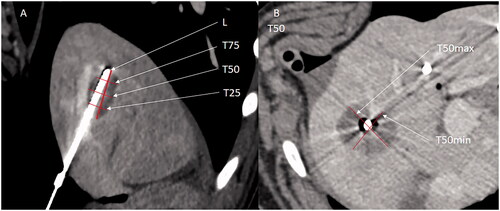 Figure 4. Example of measures of a liver ablation zone. (A) Reformat image along the axis of the antenna on enhanced CT. Measure of the long axis (L) with the antenna left in pace to better assesses the long axis. The T25, T50, and T75 of the ablation zone are shown. (B) T50min and T50max (shortest and longest measurement perpendicular to the longitudinal axis at 50% of L).