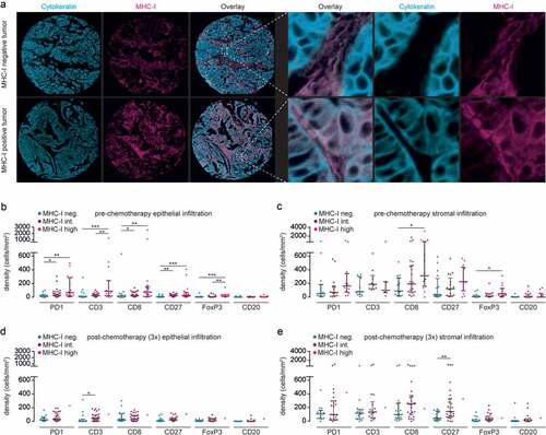 Figure 6. Treatment of HGSOC patients with neoadjuvant chemotherapy is associated with minimal expression of MHC-I.