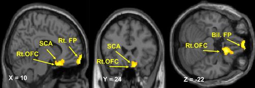 Figure 2 Resting-state functional connectivity of the right anterior insular cortex. Brain regions showing a significant increase in the functional connectivity of the right anterior insular cortex in patients with knee osteoarthritis relative to controls (p < 0.001 uncorrected, peak-level and p < 0.05 cluster-level, after FWE correction).