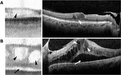 Figure 3 Macular edema appearance on swept-source OCT and spectral-domain OCT. (A and B, left) IOLMaster 700 SS-OCT scans of two different eyes with macular edema, demonstrating retinal thickening with intraretinal (black arrowheads) and subretinal fluid (black arrow). (A and B, right) Corresponding Spectralis SD-OCT scans of macular edema with intraretinal (white arrowheads) and subretinal (white arrow) fluid.