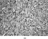 FIG. 1 Infantile fibrosarcoma composed of interlacing fascicles of spindled cells (a, b, original magnification × 100 and 200 × respectively; H & E) with minimal intervening stroma and lack of collagen matrix. The tumor cells have a moderate degree of pleomorphism with frequent mitotic figures (c, original magnification × 400 H & E). Areas within the tumor may show a prominent hemangiopericytoma-like pattern (d, original magnification × 100 H & E). Infantile fibrosarcoma possesses extracellular fibrillogranular material, which is helpful in differentiating this malignant tumor from other fibroblastic/myofibroblastic tumors (e, f, × 3,000 and × 10,000 respectively, transmission electron microscopy). After chemotherapy for a nonresectable infantile fibrosarcoma (g, original magnification × 100 H & E), the spindle cells are conspicuously absent, leaving a fibrous matrix background with a prominent bland vascular pattern.