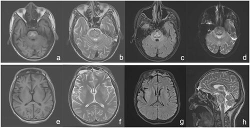 Figure 1. MRI 18 days after ingestion showing abnormal heterogeneous intensities on T1WI (a), T2WI (b and h), T2-FLAIR (c), and DWI (d) of the brainstem, particularly in the pons, in accordance with central pontine myelinolysis signal intensity. The bilateral caudate nucleus, putamen, and capsula externa showed abnormal low-intensity on T1WI (e), abnormal high-intensity on T2WI (f), and T2-FLAIR (g). DWI: diffusion-weighted imaging; FLAIR: fluid attenuated inversion recovery; MRI: magnetic resonance imaging.