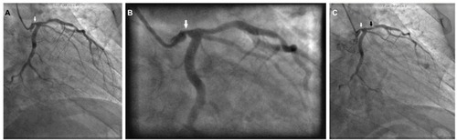 Figure 2 Left coronary artery angiography.
