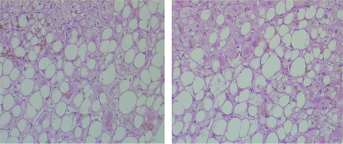 Figure 3. Macrovacuolar and heterogeneous steatotic foci predominant in the centrilobular and perivascular areas.Hematoxylin and eosin, ×400.