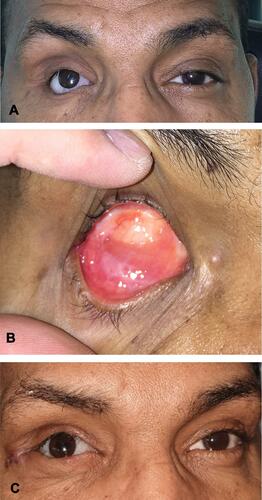 Figure 4 (A) Preoperative appearance of right phthisis bulbi with marked enophthalmos and poor prosthesis retention. (B) Complete healing at postoperative week 16 (Scalpel dissection). (C) After prosthesis fitting with good volume replacement. Lateral tarsal strip was performed.