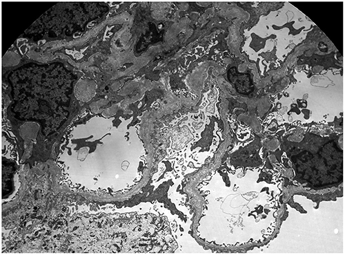 Figure 3 Electron microscopy highlighting the architectural abnormalities of the glomerular basement membranes in an Alport patient. The GBM ranges from segmentally thinned, to thickened and lamellated (x6000 magnification).