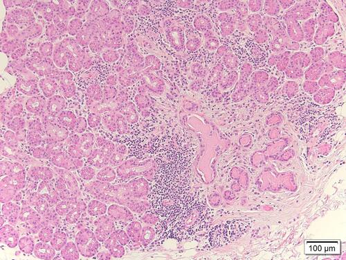 Figure 4 Chronic inflammation showing mixed lymphocytes and plasma cells infiltration (Haematoxylin-Eosin Stain H&E, magnification X100).