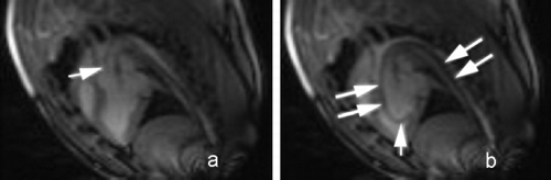 Figure 1. Real‐time True FISP sagittal images. a: tip of catheter in ascending aorta; b: tip of catheter in left ventricle (short arrow). Long arrows indicate the longitudinal profile of the catheter.