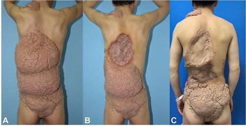Figure 1 Multiple, giant, skin-colored NLCS masses with cerebriform surfaces distributed on the back, buttock, and nuchal area before (A). 7 months after the first operation (B), the patient underwent the second surgical excision. 6 months after the second surgical excision (C).