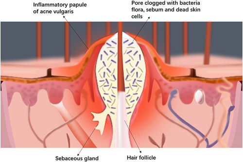 Figure 3 An illustration showing the formation of the inflammatory papule in acne.