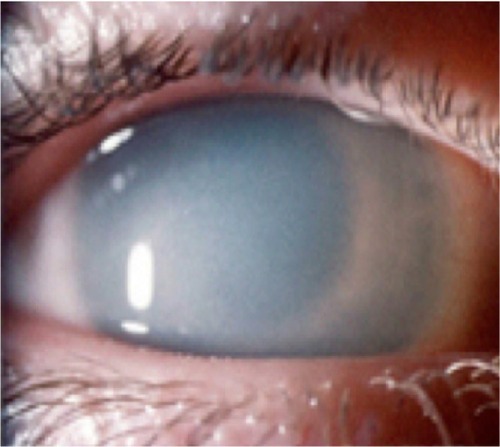 Figure 1 Corneal clouding.