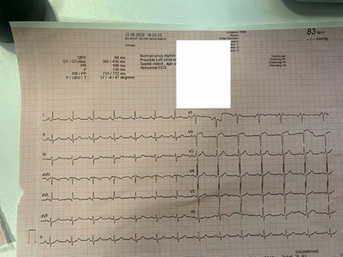 Figure 2 ECG pattern of patient with small diagonal branch (D2) occlusion. Normal T wave and ST elevation in lead V2; minimal ST elevation in lead I and aVL, and <2 mm ST depression lead III.
