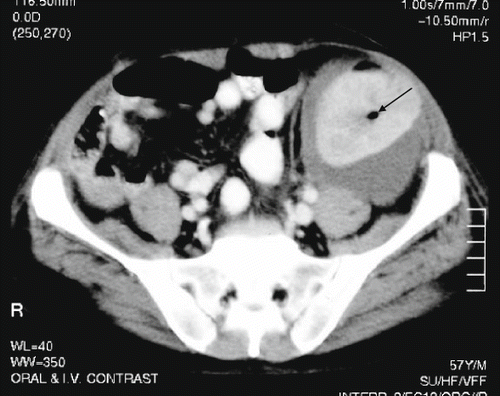 Figure 2. CT scan showing the presence of gas in the graft kidney.