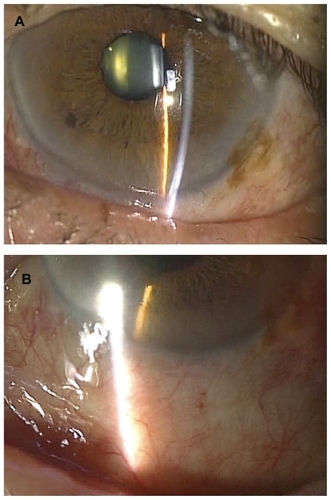 Figure 4 Photograph 1 month postoperatively. (A) The conjunctivochalasis has resolved, but slight conjunctival injection remains. (B) A white scar has formed in the coagulated region and is accompanied by mild injection. Conjunctival injection tends to be prolonged in patients with keratoconjunctivitis sicca.