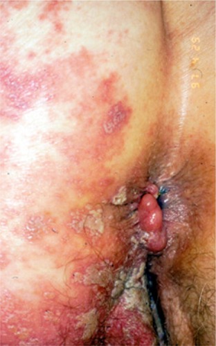 Figure 1 Severe and extensive multidermatomal unilateral HZ of the sacral dermatomes occurring during the use of TNF antagonists for psoriasis.
