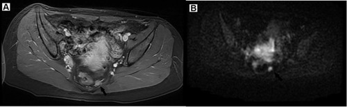 Figure 1 The T2 weighted-MR (A) and diffusion-weighted imaging (DWI, B) images of a patient with mesorectum metastatic lymph node.