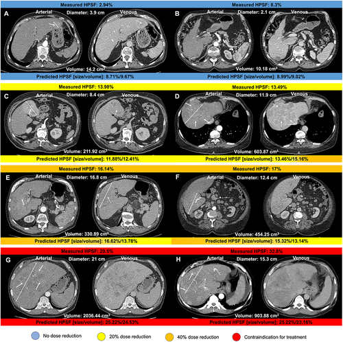 Figure 4 Arterial and venous axial contrast-enhanced CT images displaying hepatocellular carcinoma lesions (two-sided arrows indicate the maximum diameter of the index lesion) of patients recommended for transarterial radioembolization. Hepatopulmonary shunt fraction (HPSF) measured following angiography is shown above each image. Predicted HPSF using the predictive model based on imaging and clinical disease-specific parameters are shown below each image. Examples of non-rim arterial phase enhancement and washout are indicated by solid and dotted arrows, respectively. Recommendations for dose reduction and contraindications for yttrium-90 microspheres administration are color-coded. HPSF displayed in (A and B) resulted in no dose reduction; HPSF displayed in (C and D) resulted in 20% dose reduction; HPSF displayed in (E and F) resulted in 40% dose reduction; HPSF displayed in (G and H) were interpreted as a contraindication for treatment.Citation15