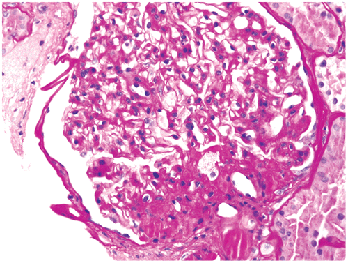 Figure 2: Obesity-related perihilar focal segmental glomerulosclerosis on a background of glomerulomegaly. Periodic Acid-Schiff stain, original magnification 400x.