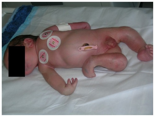 Figure 1 Clinical picture of the child who was nonambulatory at last follow-up, showing severe involvement of the upper and lower limbs at birth.