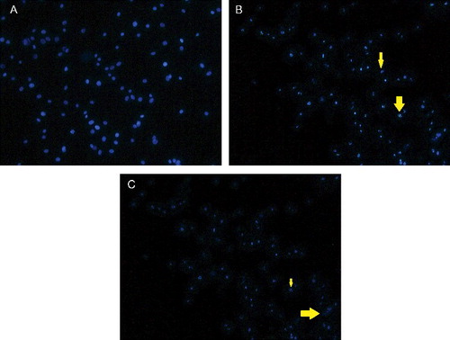 Figure 4. Fluorescence microscopy of MDA-MB231 cells treated with (A) vehicle, (DMSO; control), TAM (B) and TAM-loaded SLN (C). Cell shrinkage (thin arrow) and apoptotic cells (thick arrow) are evident (magnification ×40).