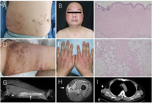 Figure 2 (A and D): The cicatrix, fibrocollagenous nodules and multiple calcifications in abdomen and thighs. (B and E): The characteristic features of dermatomyositis: Heliotrope sign, V sign and Gottron sign. (C) (HE×40) and (F) (HE×100): Biopsy of the subcutaneous firm nodules in the trunk revealed localized collagen hyperplasia in the dermis, accompanied by significant mucin deposition, as well as adipose septal fibrosis and hyalinization in the subcutaneous adipose tissue, featuring lipomatous cysts and membranous changes, with a minor infiltration of lymphocytes in the dermis and subcutaneous adipose tissue. (G and H): T1-weighted MR images revealed high signal intensity in sartorius muscle (white arrows) and intermuscular space. (I): The chest CT scan identified subcutaneous calcified nodules (white arrow).