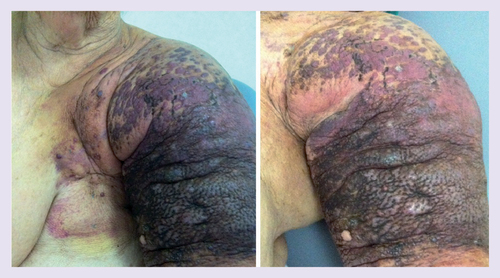 Figure 1.  Cutaneous lymphangiosarcoma of Stewart–Treves syndrome.Clinical presentation of confluent angiomatous purple and black nodules on the mastectomy scar on the left chest wall and the left upper limb, with bleeding and hemorrhagic crusts.