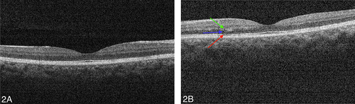 Figure 2 (A) Optical coherence tomography (OCT): OD slight disruption of nasal parafoveal outer photoreceptor segments and interdigitation zone. (B) Optical coherence tomography (OCT): OS focal atrophy and excavation of nasal parafoveal outer photoreceptor segments and interdigitation zone. Blue arrow: Outer nuclear layer; Red arrow: Photoreceptors; Green arrow: Outer plexiform layer.