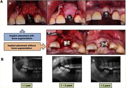 Figure 2 The differences in the bone augmentation group and the period of teeth loss group. (A) Implant placement with (a, b, c) or without (d, e) bone augmentation. (B) Typical X-ray pictures of the period of teeth loss in different patients: (f) the period of teeth loss was less than 1 year; (g) the period of teeth loss was 1–2 years, there was a tilting of adjacent teeth; and (h) the period of teeth loss was more than 2 years, elongation of paired jaw teeth, tilting of adjacent teeth, and insufficient repair space are obviously shown.
