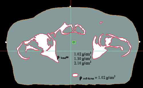 Figure 1.  Simulated MR-image segmented into the two tissue classes soft tissue and bone. Soft tissue was assigned the water equivalent density of 1.02 g/cm3, whereas bone was assigned the densities 1.02 g/cm3 (water equivalent), 1.3 g/cm3 (mixture of cortical bone and trabecular bone/cartilage), and 2.1 g/cm3 (compact bone), respectively.