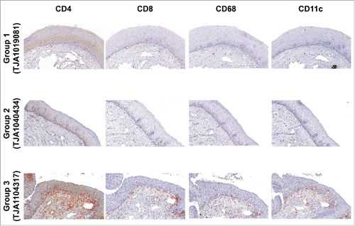Figure 1. Association between cervical histopathology status and increased cervical cell density per square millimeter in ART-treated HIV+/HPV+ women. Immunohistochemical staining for CD4+, CD8+, CD68 and CD11c is shown in epithelium and stroma from cervical biopsies of representative women in each group: HR (-) HPV with negative cervical histopathology (group 1, study subject TJA1019081, top panel), HR (+) HPV with negative cervical histopathology (group 2, study subject TJA1040434, middle panel), and HR (+) HPV with CIN1 or CIN2/3 (group 3, study subject TJA1104317, bottom panel).