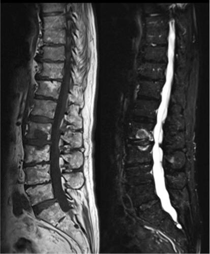 Figure 3 Aseptic spondylodiscitis. Sagittal T1-weighted and STIR sequences in a patient with longstanding psoriatic arthritis show disc oedema with subchondral bone marrow involvement at L2-L3 level, consistent with aseptic spondylodiscitis (Andersson lesion).