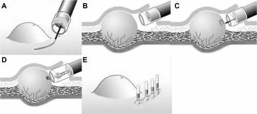 Figure 2 TBB procedure using submucosal endoscopy with the mucosal flap method for GI subepithelial tumors.