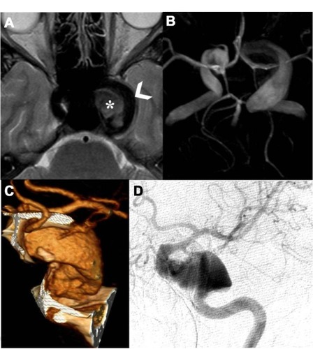 Figure 2 Magnetic resonance (MR) axial T2-weighted cerebral study shows flow-void signal of patent intracavernous side carotid siphon (arrowhead), and, medially, intravascular characteristic signal modification to refer breakdown hemoglobin products of thrombus (asterisk) (A); time-of-flight MR angiography (TOF-MRA), using a maximum-intensity projection (MIP) algorithm with 3-D MIP reconstruction, detailed two intracranial fusiform aneurysms, one at the left internal carotid artery (ICA) as a giant fusiform intracavernous aneurysm (larger than 25 mm in diameter), and the second as a contralateral smaller aneurysm (12 mm larger) (B); angio-computed tomography (A-CT) shaded surface display reconstruction (SSD) study shows magnified detail of left partially thrombosed fusiform giant aneurysm (C); left selective ICA digital angiography anteroposterior view confirms the partially thrombosed giant intracavernous aneurysm (D).