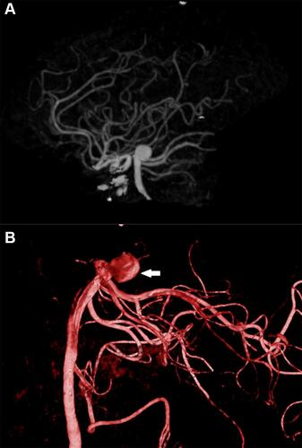 Figure 3 (A) Hemodynamically stable basilar tip aneurysm. The aneurysm is inclined posteriorly with smooth aneurysmal dome. (B) 3D lateral angiogram shows a unilocular saccular aneurysm arising from the basilar tip with posterior inclination (arrow).