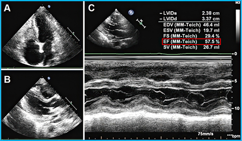 Figure 4 Echocardiogram of Loeffler endocarditis causing heart failure with preserved ejection fraction. (A) Left ventricular hypertrophy and complete apical obliteration; (B) Right ventricular thrombus; (C) Preserved ejection fraction (EF) of 58% (red square).